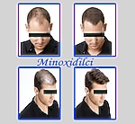 6Adet Minoxidil Pak Darou Orjinal 2027Skt